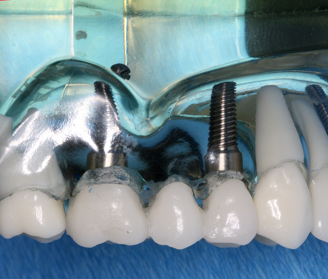 un implante dental