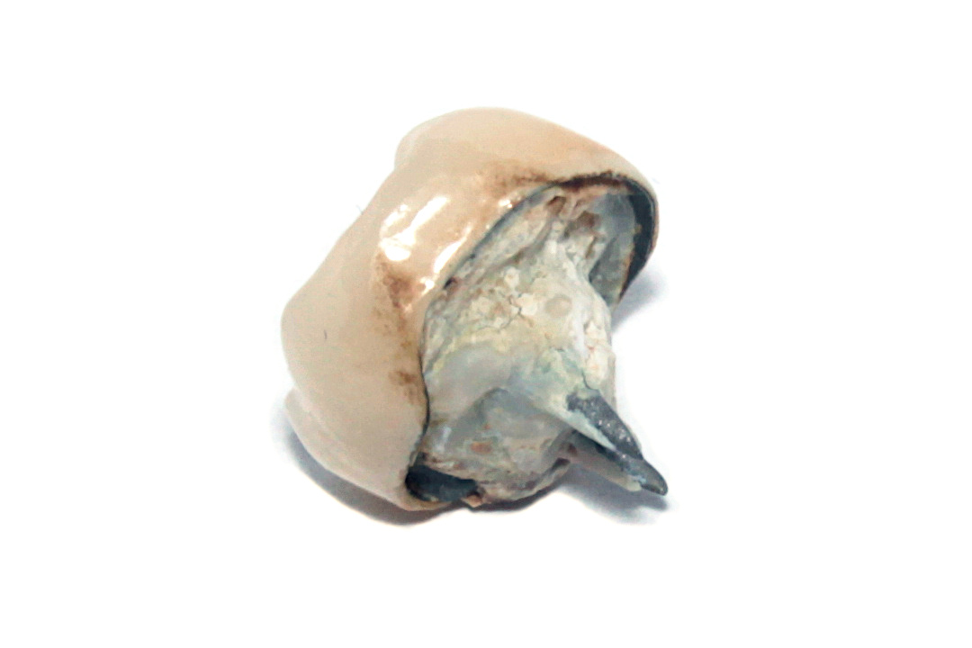 una corona dental