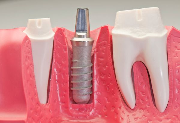 un implante dental