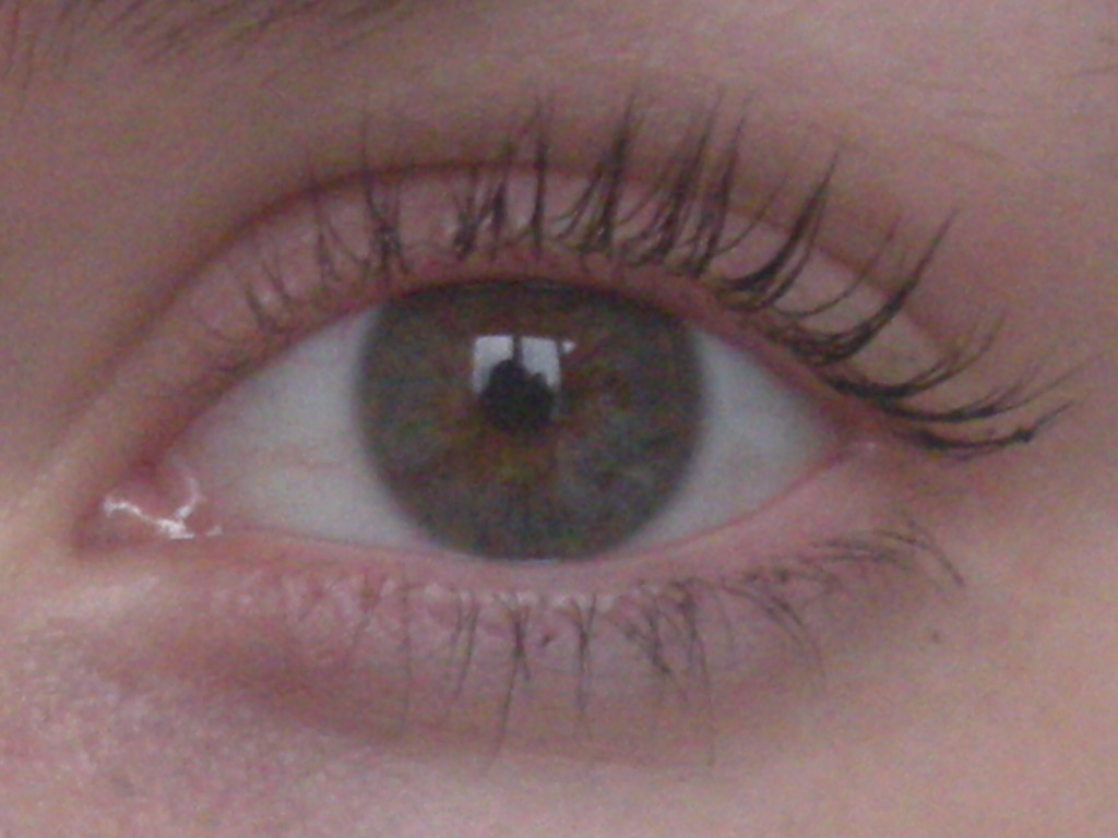 una blefaroplastia